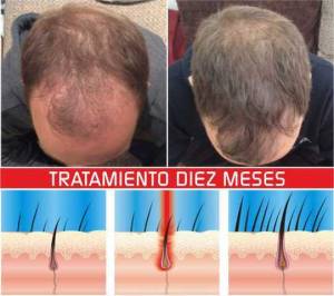 LASER DOME 110 LASER. TERAPIA LASER ALOPECIA. AGA.